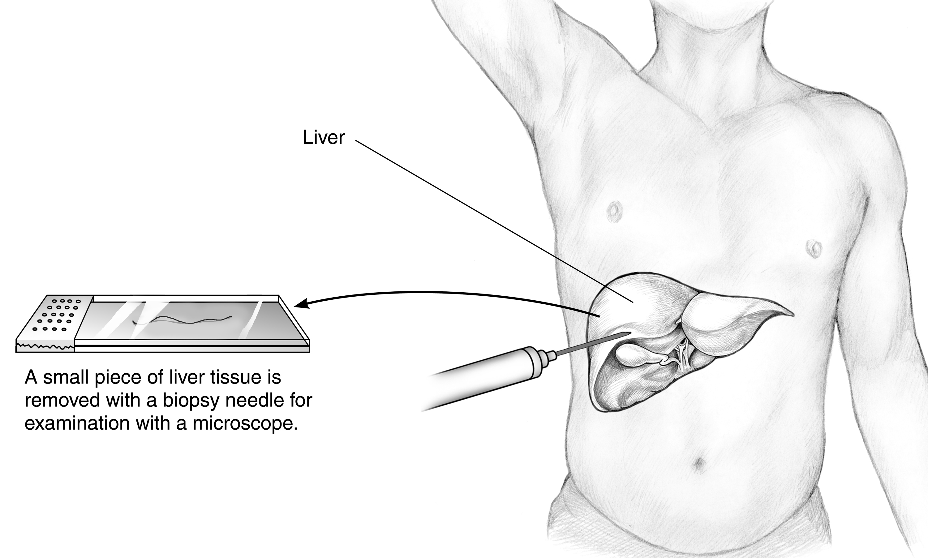 Percutaneous liver biopsy with a needle pricking the liver tissue, and