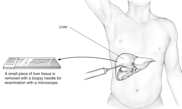 Drawing of a percutaneous liver biopsy, showing a liver within an outline of a male body, a needle pricking the liver tissue, and a slide with the tissue sample.