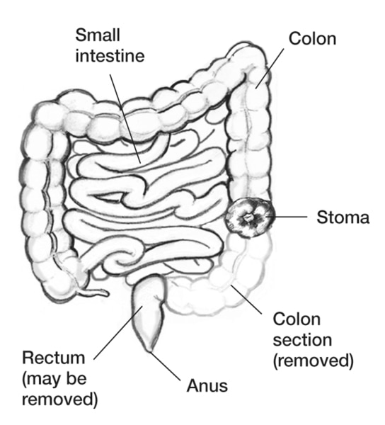 Drawing of the colon with a portion of the descending colon missing and remaining colon diverted to a stoma labeled.
