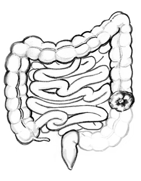Drawing of the colon with a portion of the descending colon missing and remaining colon diverted to a stoma.