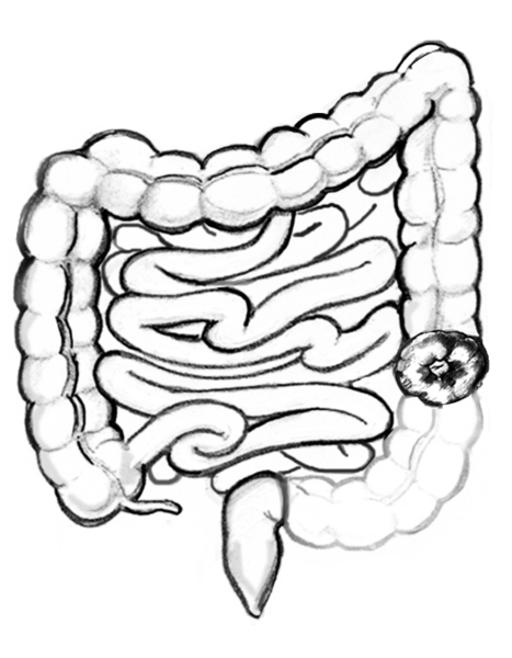 Drawing of the colon with a portion of the descending colon missing and remaining colon diverted to a stoma.