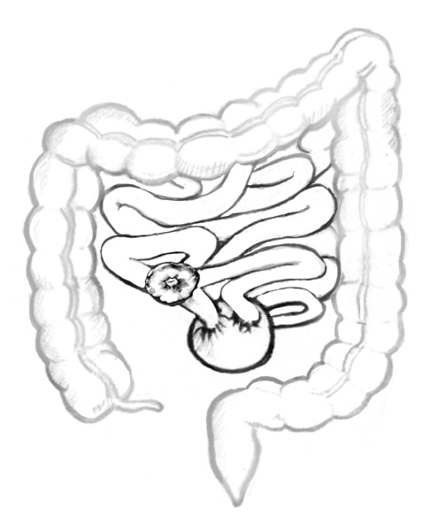 Drawing of the small intestine diverted through a pouch and then to a stoma.