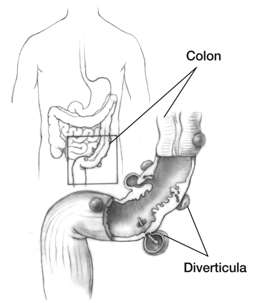 Drawing of the colon and an enlargement of it showing diverticula.