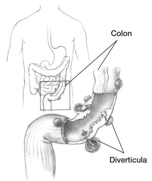 Drawing of the colon and an enlargement of it showing diverticula.