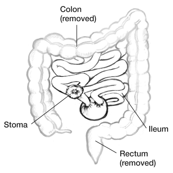 Drawing of the small intestine diverted through a pouch and then to a stoma.  The removed colon and rectum are labeled.