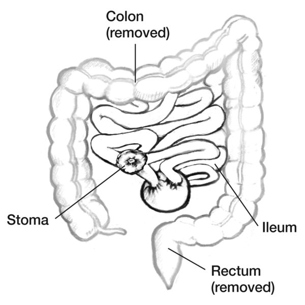 Drawing of the small intestine diverted through a pouch and then to a stoma. The removed colon and rectum are labeled.