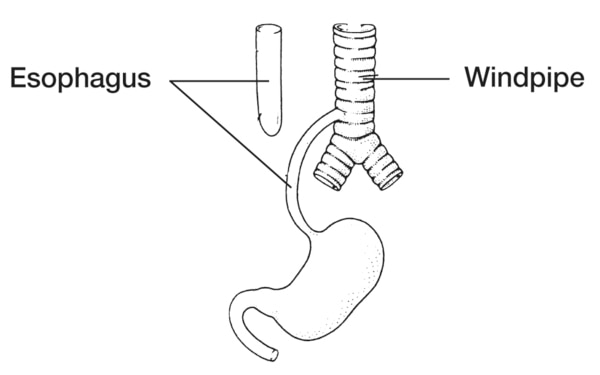 Drawing of the esophagus with a portion of the esophagus emerging from the windpipe.