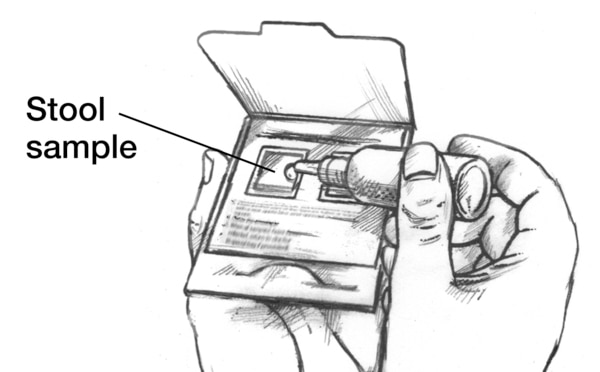 Drawing of hands holding a card containing a stool sample. A drop of liquid is being applied to the stool sample to test for fecal occult blood. Label point to stool sample.