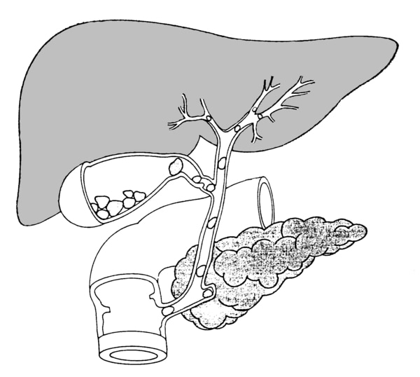 Drawing of the biliary tract with stones in the gallbladder and common bile duct.