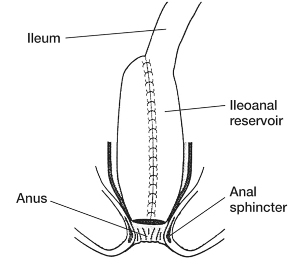 Drawing of an ileoanal pouch anastomosis with the ileum, ileal reservoir, anus, and anal sphincter labeled.