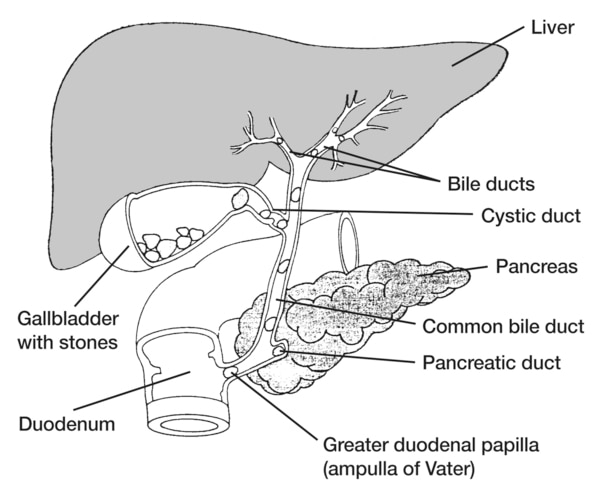 Drawing of the biliary tract with stones in the gallbladder and common bile duct. The labels point to liver, bile ducts, cystic duct, pancreas, gallbladder with stones duodenum, common bile duct, pancreatic duct and greater duodenal papilla.