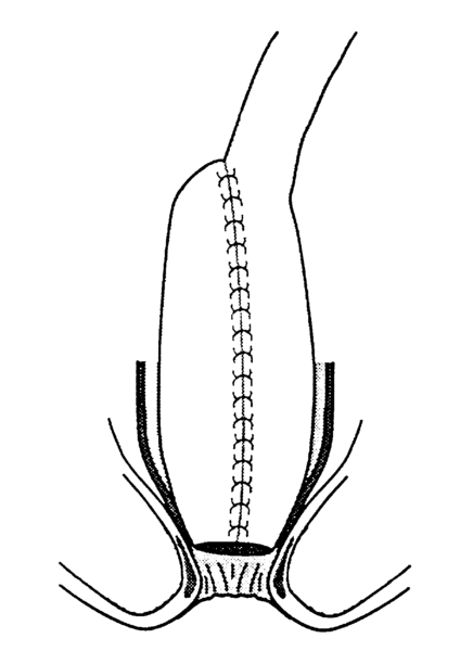 Drawing of an ileoanal pouch anastomosis with the ileum, ileal reservoir, anus, and anal sphincter.