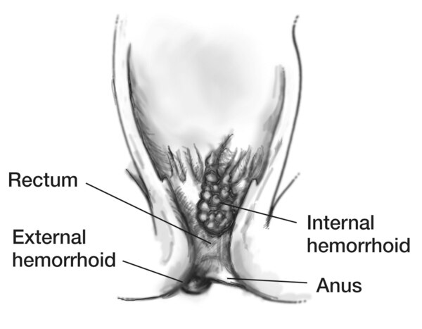 Drawing of the rectum and anus with an internal hemorrhoid and an external hemorrhoid labeled.