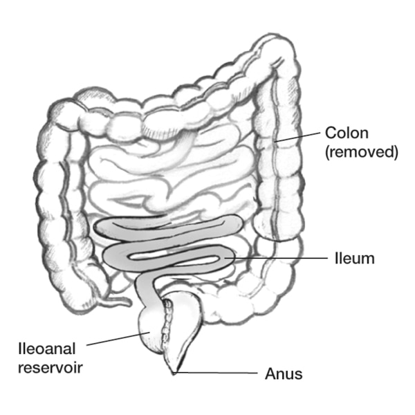 Drawing of an ileoanal reservoir with the anus, ileum, removed colon, and ileoanal reservoir labeled.