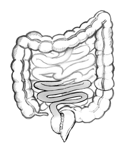 Drawing of an ileoanal reservoir with the anus, ileum, removed colon, and ileoanal reservoir.