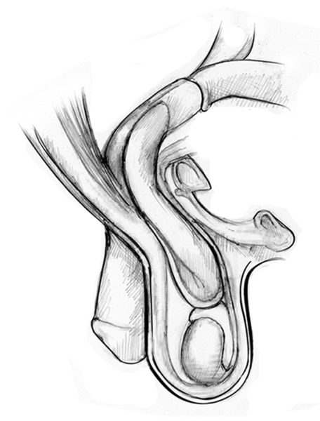 Drawing of an inguinal hernia with the small intestine, internal inguinal ring, external inguinal ring, pubic bone, penis, spermatic cord, and testes.