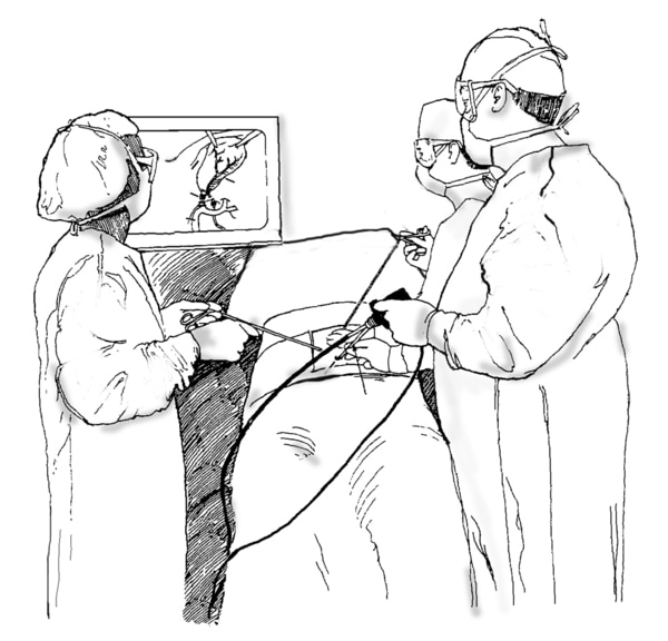 Drawing of laparoscopic cholecystectomy. A surgeon and assistants hold the laparoscope and view the procedure on a monitor.