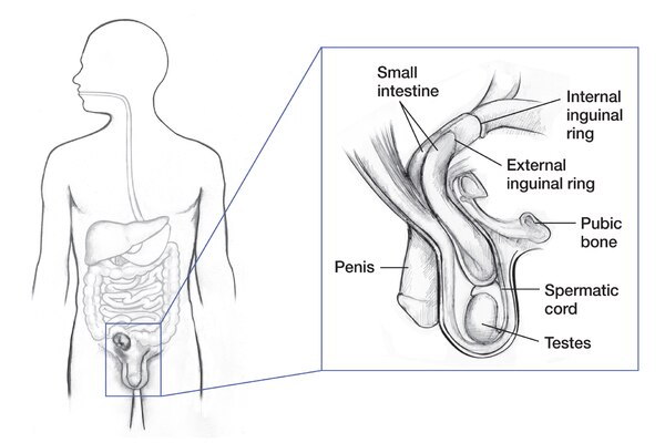 Drawing of the digestive tract within the outline of a male body with an inset showing an inguinal hernia. Labels point to small intestine, internal inguinal ring, external inguinal ring, pubic bone, penis, spermatic cord, and testes.
