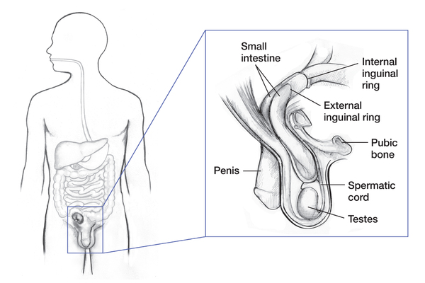 Drawing of the digestive tract within the outline of a male body with an inset showing an inguinal hernia. Labels point to small intestine, internal inguinal ring, external inguinal ring, pubic bone, penis, spermatic cord, and testes.