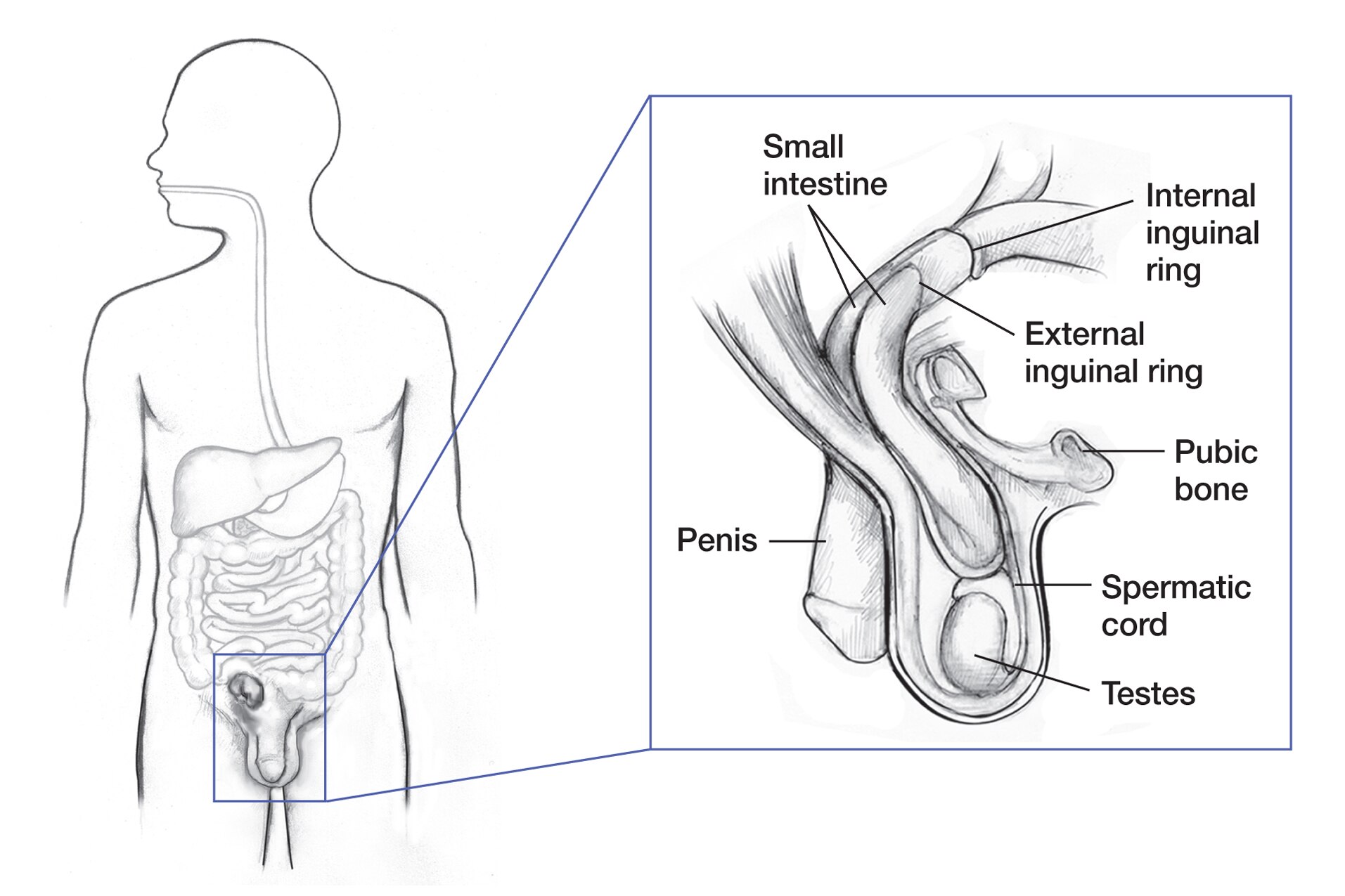 Medbullets - Direct inguinal hernias can be distinguished... | Facebook