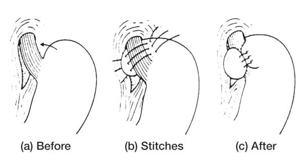 Drawings of the stomach and esophagus: before the Nissen fundoplication operation, with stitches, and after the Nissen fundoplication operation.