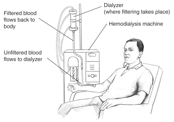 Drawing of a man having a hemodialysis treatment. Labels point to the dialyzer, filtered and unfiltered blood, and hemodialysis machine.