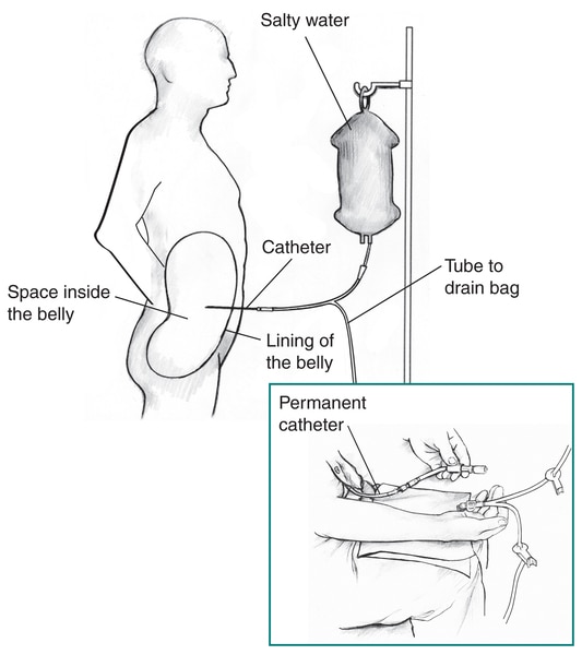 Profile outline of a male figure receiving peritoneal dialysis. An inset shows a man holding his permanent catheter and a disconnected tube over his lap.