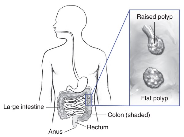 Drawing of the digestive tract within outline of a male body, with labels pointing to the large intestine, colon (shaded), rectum, and anus. Inset shows a section of colon with a raised and a flat polyp