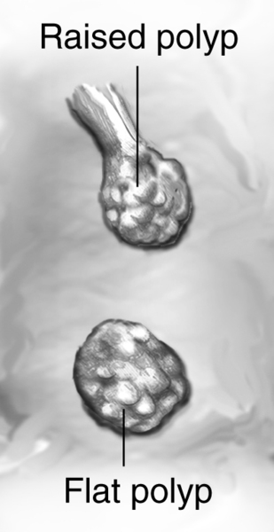 Drawing of a section of colon with labels pointing to a raised and flat polyp.