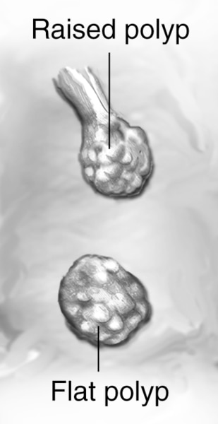 Drawing of a section of colon with labels pointing to a raised and flat polyp.