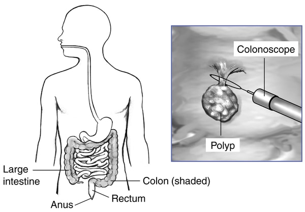 Drawing of the digestive tract with labels for the large intestine, colon, rectum, and anus. Inset shows a colonoscope removing a raised polyp from the colon.