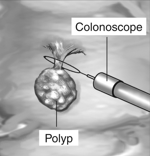 Drawing of a colonoscope removing a raised polyp from the colon with labels.