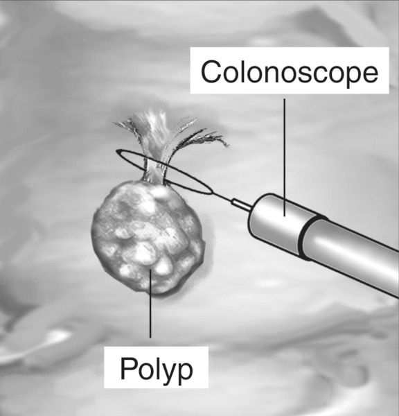 Drawing of a colonoscope removing a raised polyp from the colon with labels.