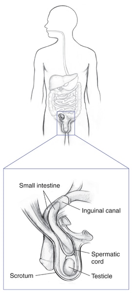 Drawing of the digestive tract within the outline of a male body with an inset showing an indirect inguinal hernia in a male. Labels point to small intestine, inguinal canal, spermatic cord, scrotum and testicle.