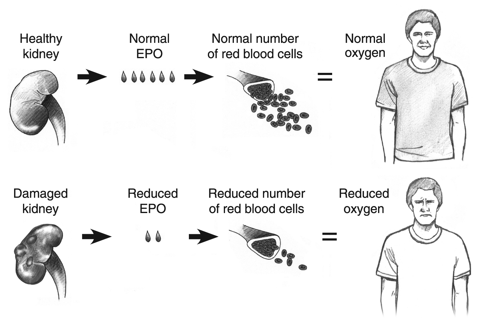 Reduced red blood cell production versus normal production Media
