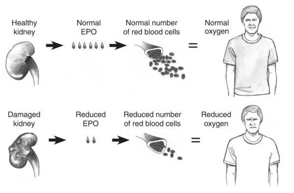 Top: process of normal red blood cell production with a healthy kidney. Bottom: process of reduced red blood cell production with a damaged kidney
