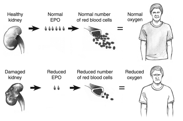 Top: process of normal red blood cell production with a healthy kidney. Bottom: process of reduced red blood cell production with a damaged kidney