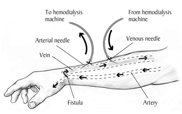 Drawing of a labeled forearm with an AV fistula. Needles and tubes are inserted into the AV fistula. Arrows show direction of blood flow.