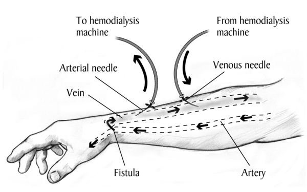 Drawing of a labeled forearm with an AV fistula. Needles and tubes are inserted into the AV fistula. Arrows show direction of blood flow.