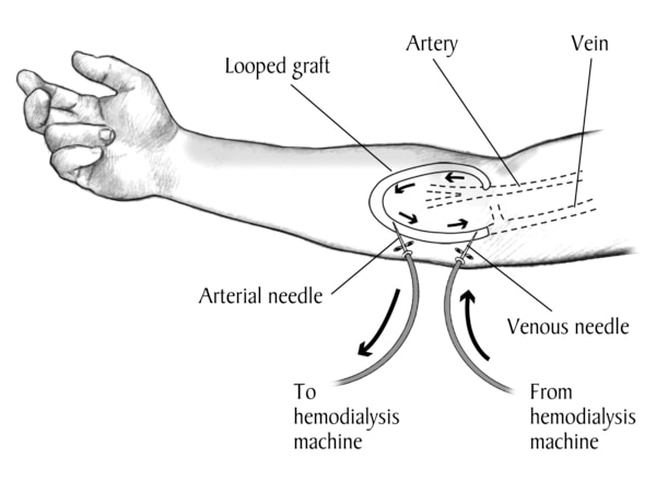 Drawing of a labeled forearm with an AV graft. Needles and tubes are inserted into the tube that connects the artery to the vein. Arrows show direction of blood flow.