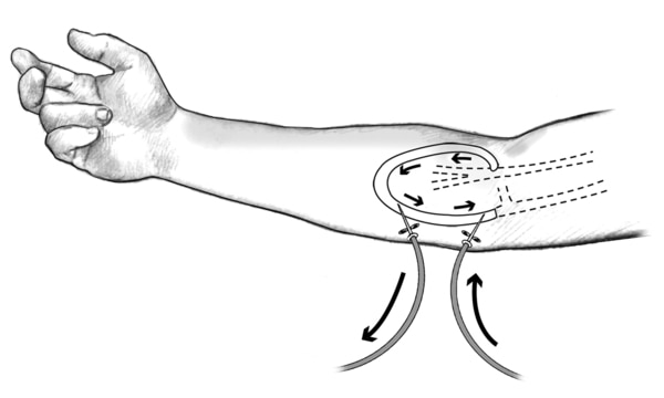 Drawing of a forearm with an AV graft. Needles and tubes are inserted into the tube that connects the artery to the vein. Arrows show direction of blood flow.