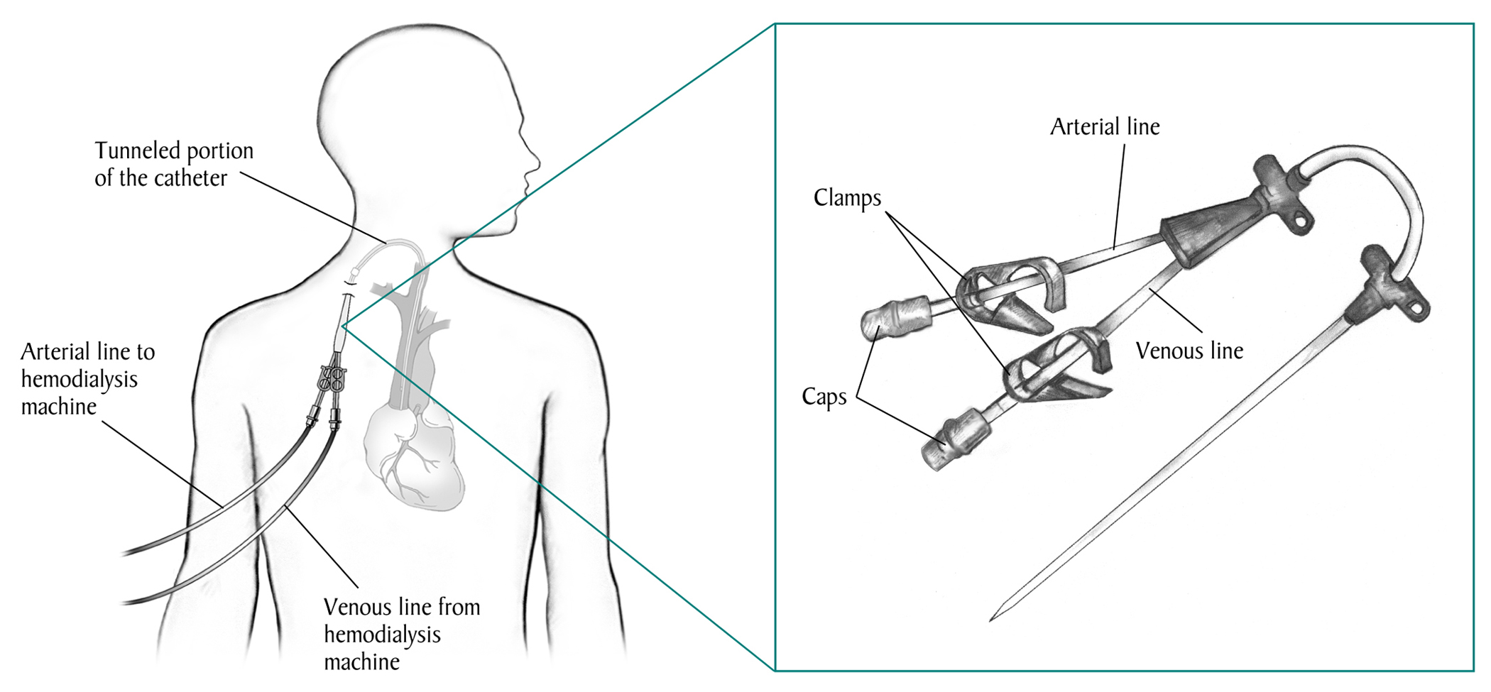 Man with a venous catheter in his neck and tubes that connect to a