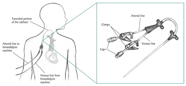 Outline of a man with a venous catheter in his neck and tubes that connect to a hemodialysis machine. Inset shows close-up of the catheter.
