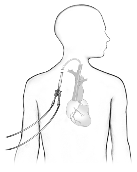 Outline of a man with a venous catheter in his neck and tubes that connect to a hemodialysis machine.
