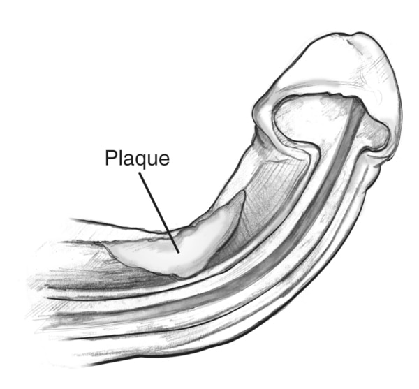 A cross section of a curved penis during an erection, label pointing to the location of plaque.