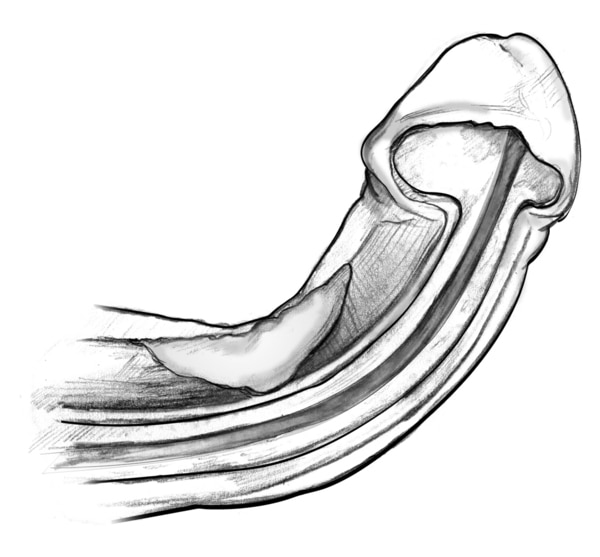 A cross section of a curved penis during an erection, includes location of plaque.