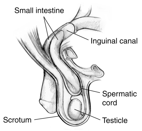 Drawing of an inguinal hernia with labels pointing to small intestine, inguinal canal, spermatic cord, scrotum and testicle.