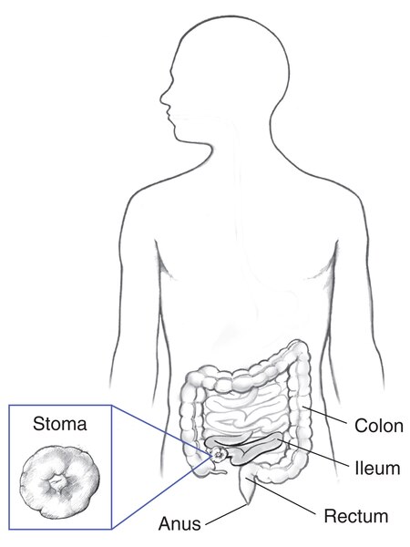 Drawing of the colon, ileum, stoma of the ileum, rectum, and anus within an outline of the human body. Inset shows a detailed drawing of the stoma.