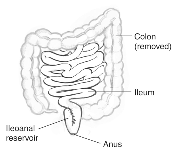 Drawing of the removed colon, labels pointing to the colon (removed), ileum, ileoanal reservoir, and anus.