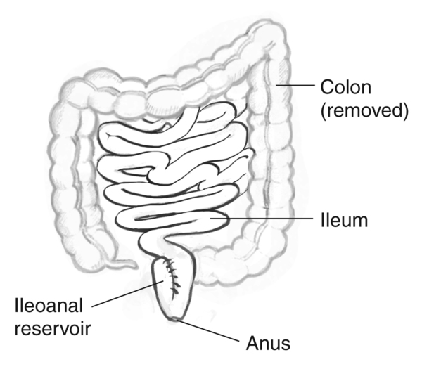 Drawing of the removed colon, labels pointing to the colon (removed), ileum, ileoanal reservoir, and anus.